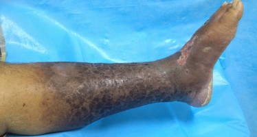 SÍNDROME PÓS-TROMBÓTICA